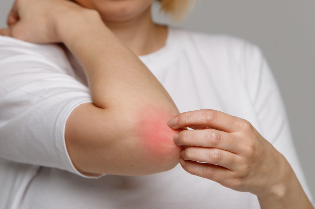 redness-of-skin
